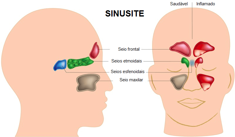 Esquema mostrando como a sinusite afeta a face