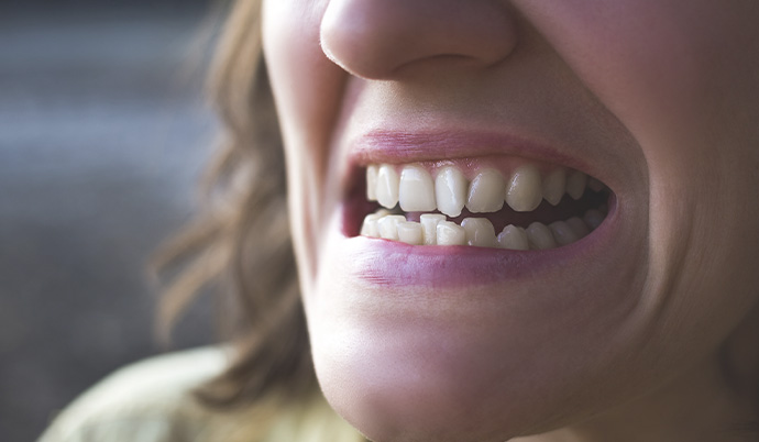 mulher sorrindo mostrando seus dentes tortos