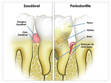 Comparação entre dente saudável e dente com periodontite juvenil
