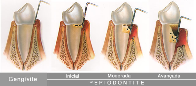 periodontista em Curitiba