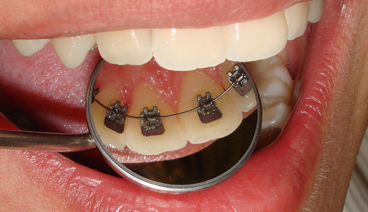 aparelho dental lingual