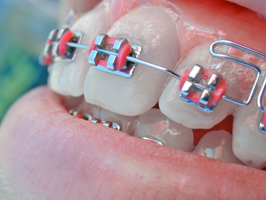 aparelho dental tradicional