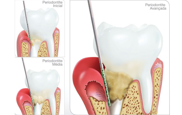 doenças gengivais periodontite