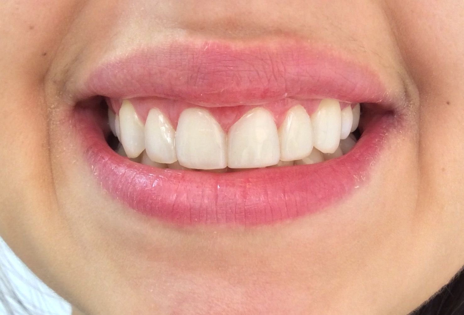 Facetas Resina KL 2 - Cury Clínica Odontológica