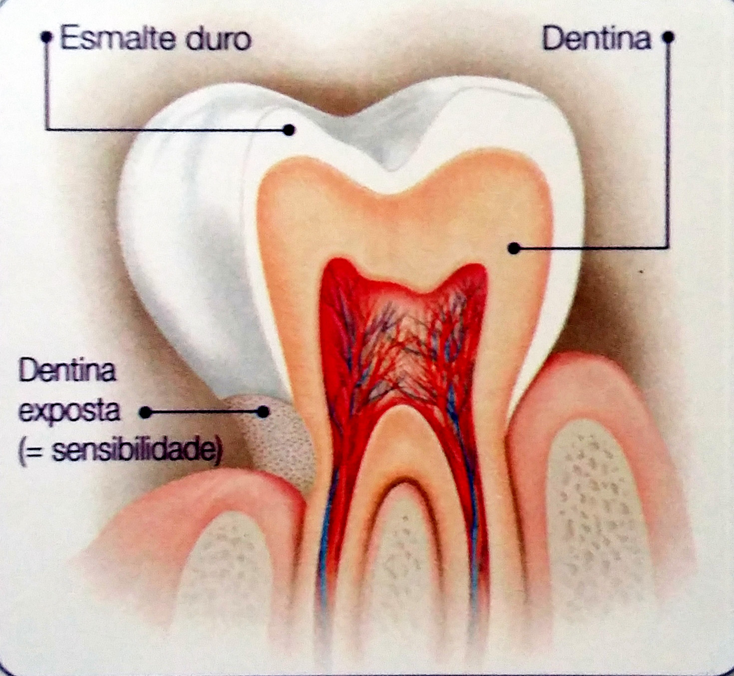 dente-sensivel