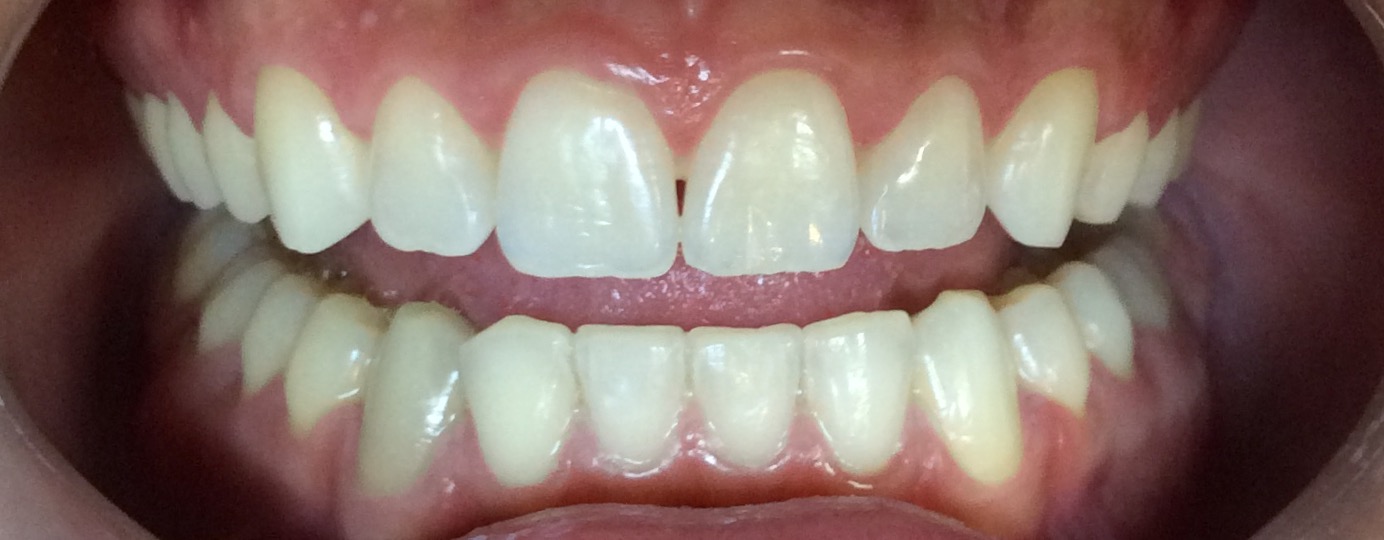 clareamento dental caseiro- Cury Odontologia 3