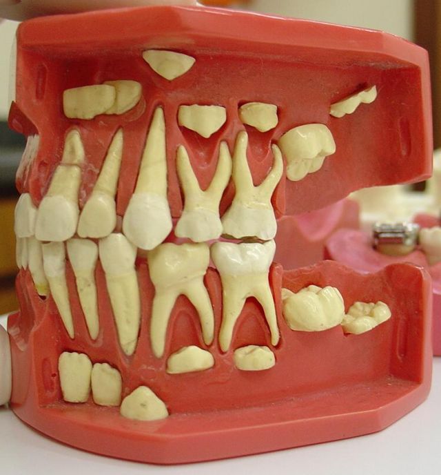 denticao-traumatismo-dentario