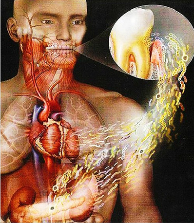 Demonstração do corpo humano sendo afetado por problemas bucais