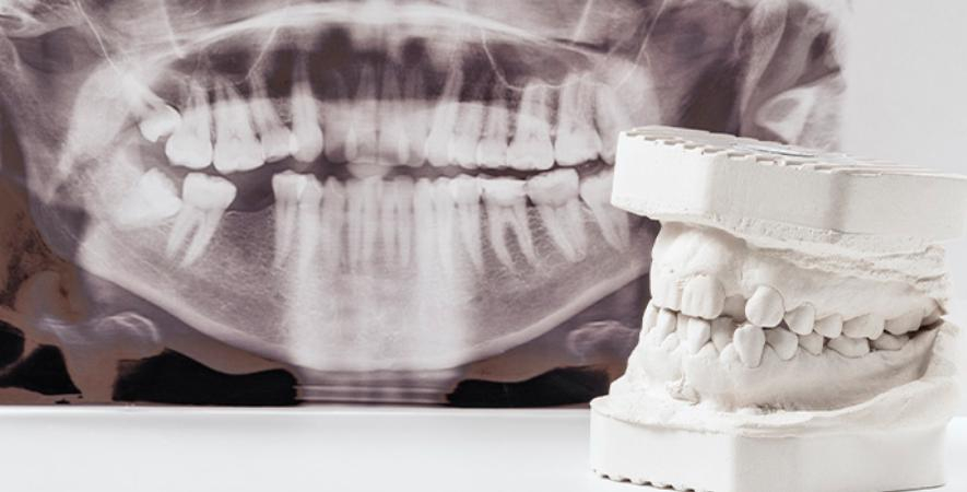Conheça os motivos para perda óssea dentária