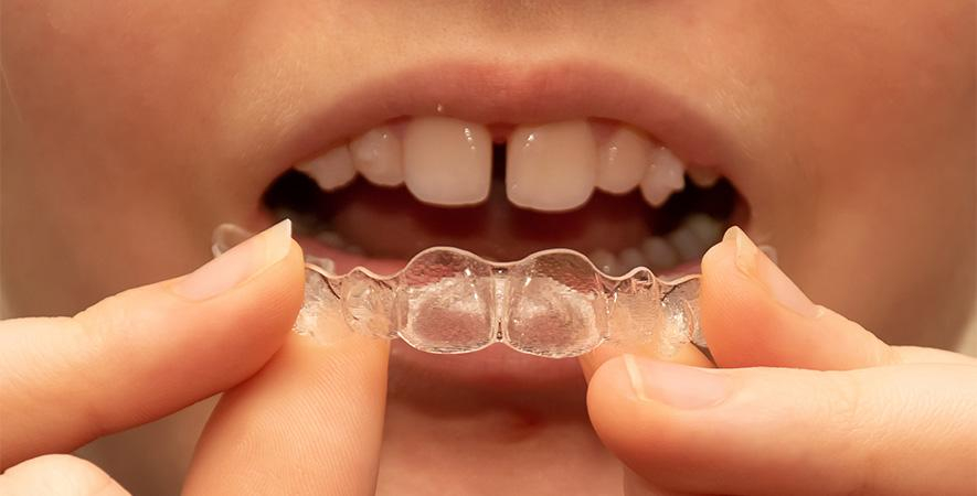 Invisalign First: O aparelho dental ideal para crianças