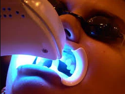 Paciente realizando um procedimento de clareamento dental
