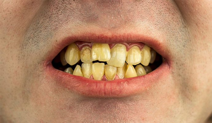 homem mostrando dentes muito amarelos e sujos