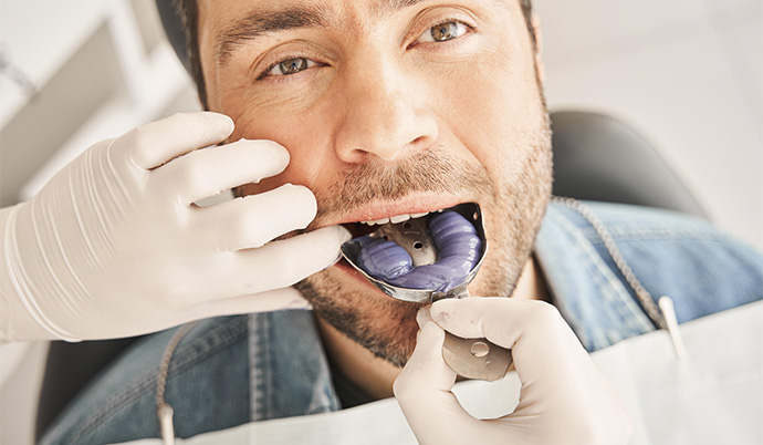 dentista fazendo um molde da arcada dentária de uma homem