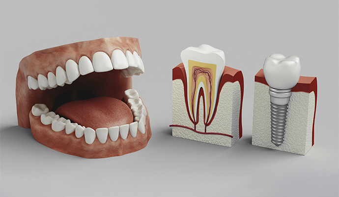 modelo de uma arcada dentária ao lado de dois modelos de implante dentário