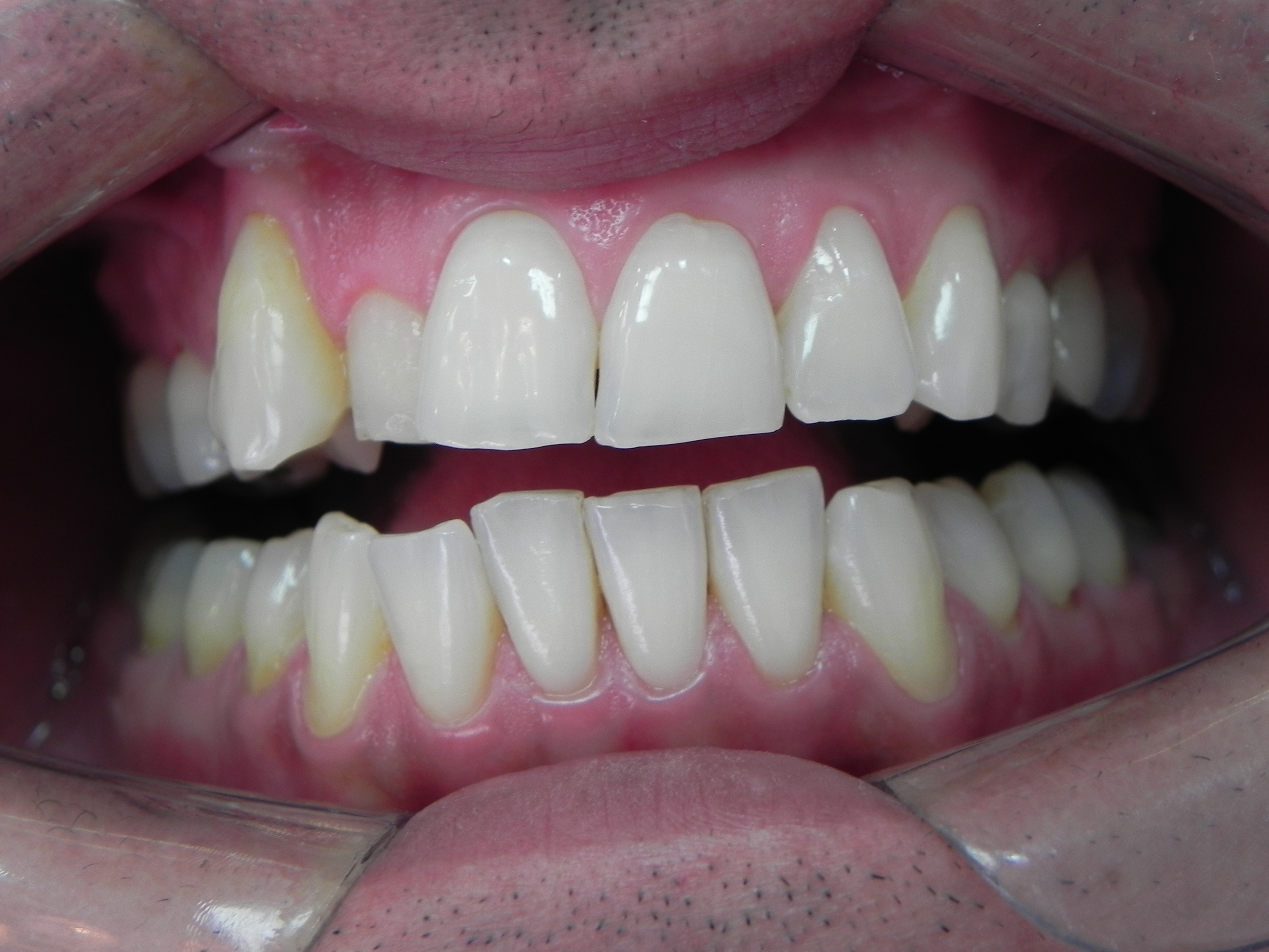 Dentes brancos após clareamento