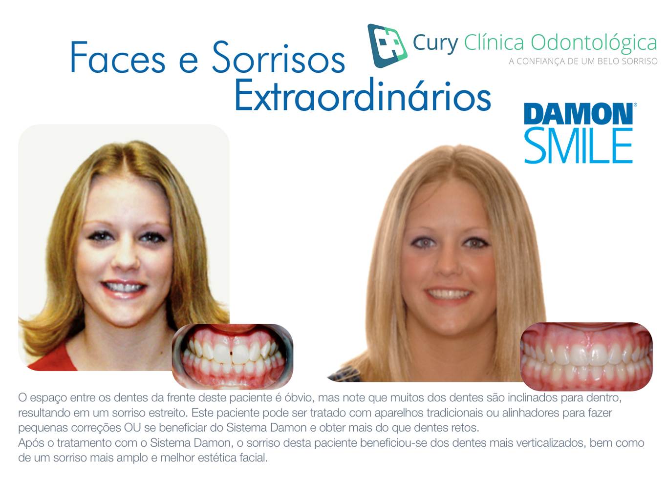 Antes e depois do tratamento com Damon System. Na esquerda mulher com dentes desalinhados e na direita mulher com dentes alinhados