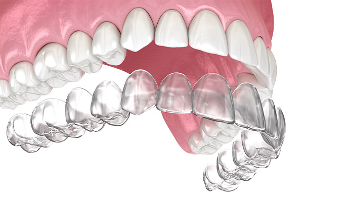 representação 3D de como uma placa de alinhador Invisalign se encaixa nos dentes