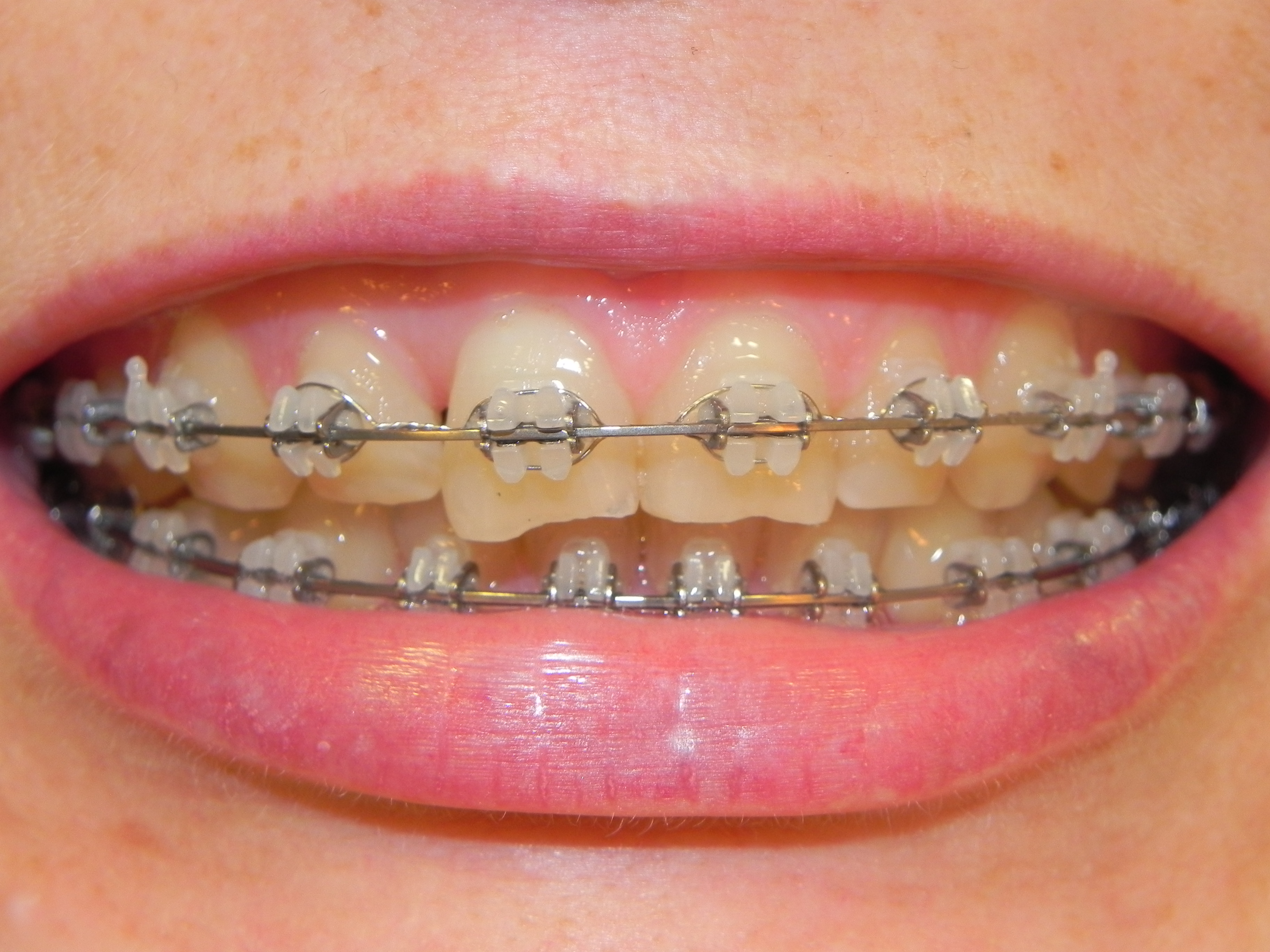 Paciente com aparelho ortodôntico, dentes desalinhados