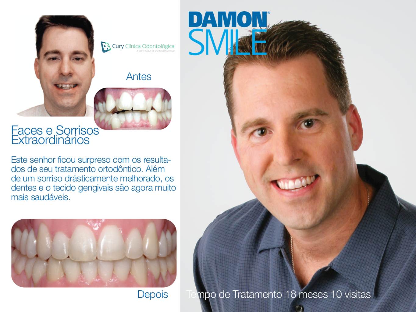 Antes e depois de tratamento com Damon System. Homem com sorriso desalinhado na esquerda e sorriso alinhado na direita