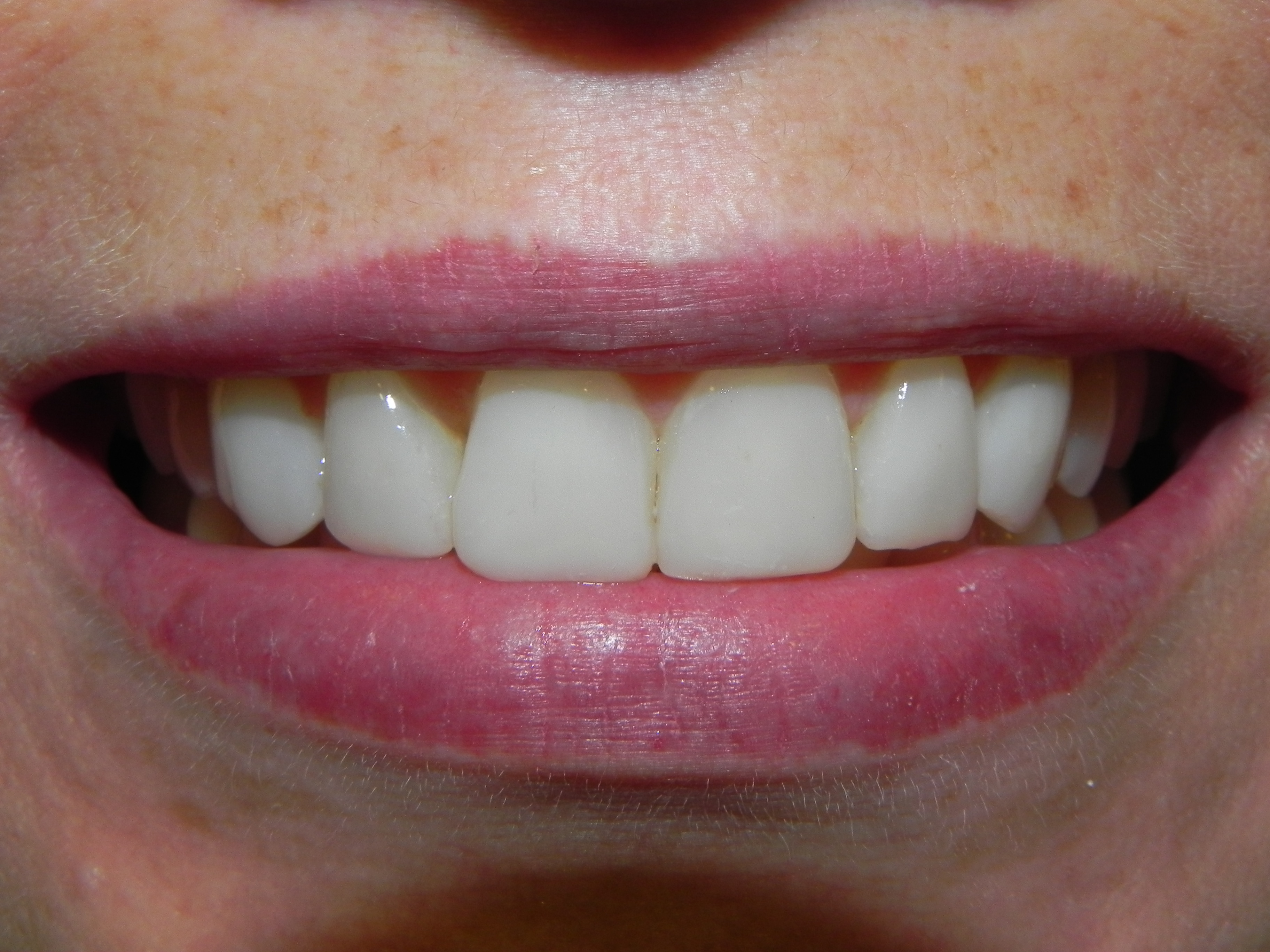 Paciente após tratamento com aparelho ortodôntico, dentes alinhados