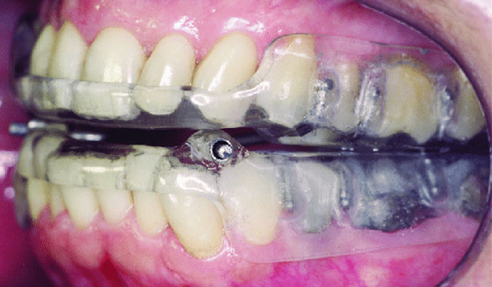 Vista intra oral de um aparelho reposicionador mandibular, um dos tratamentos indicados para apneia do sono.