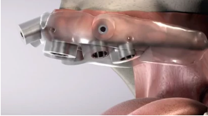 Cirurgia de implantes dentários