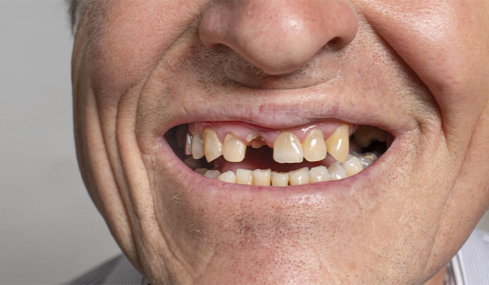 idoso sorrindo e alguns de seus dentes estão faltando