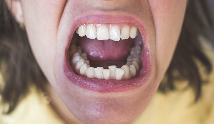 mulher mostrando os dentes com má oclusão