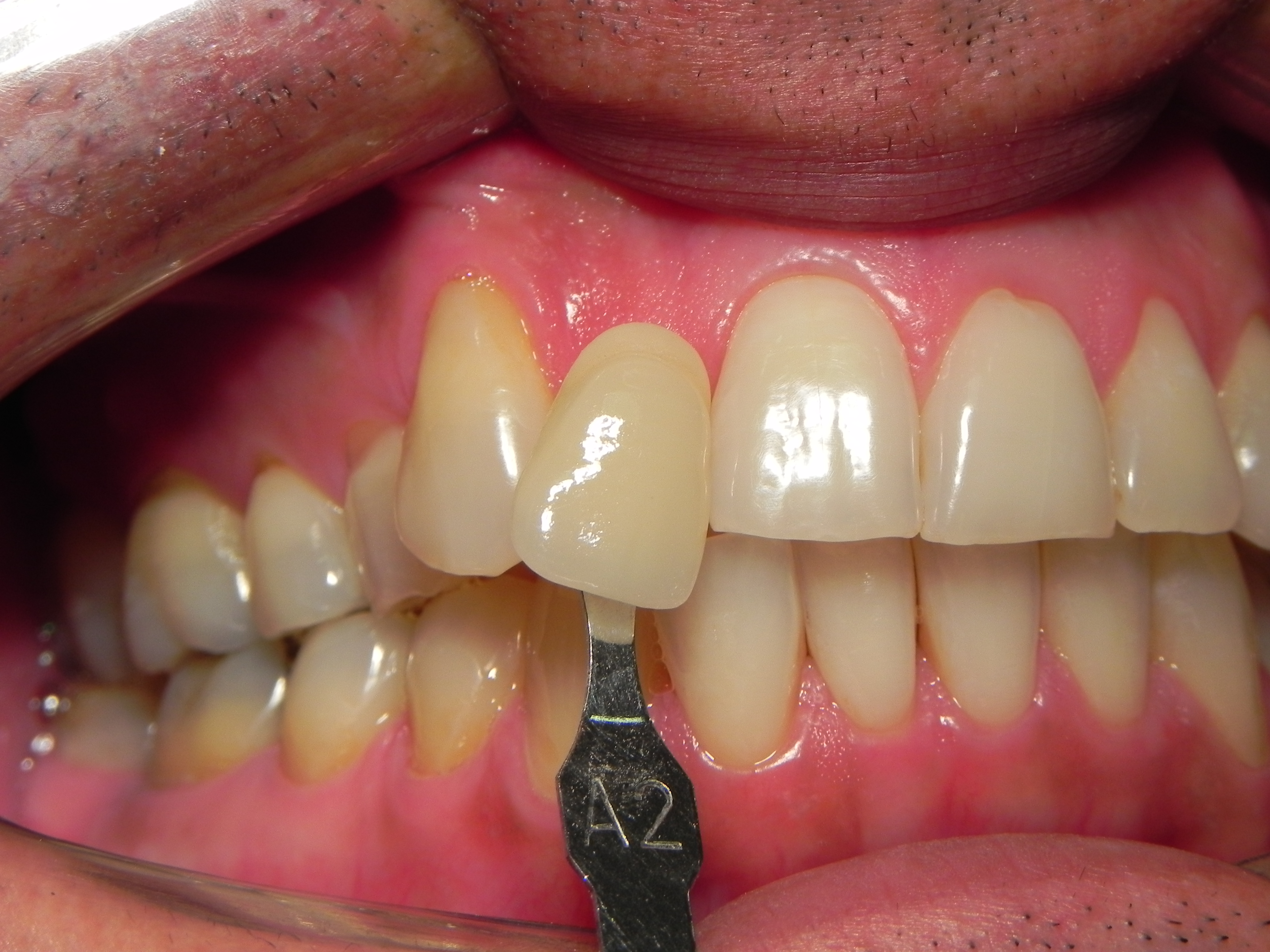 Dentes amarelados antes do clareamento